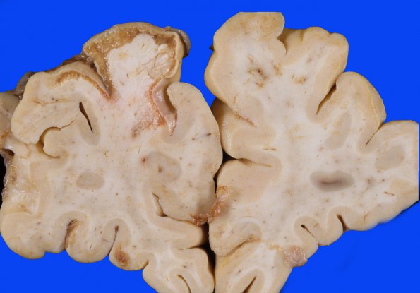 15 Infarct, subacute (Case 15) A