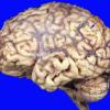 16A1 Infarct, subacute (Case 16) b copy