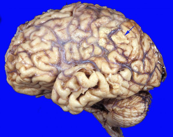 16A1 Infarct, subacute (Case 16) b copy