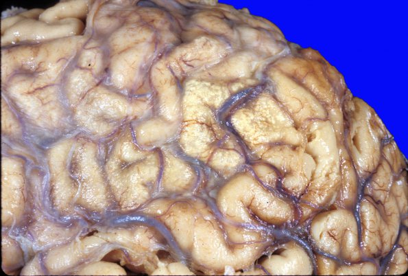 16A2 Infarct, subacute (Case 16) c