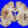 16A3 Infarct, subacute (Case 16) a