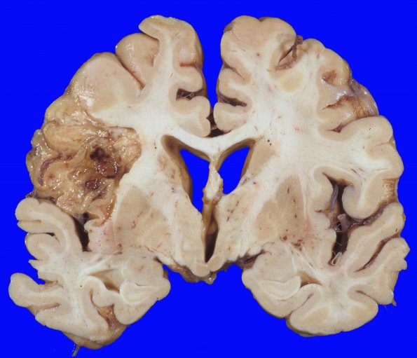 16A3 Infarct, subacute (Case 16) a