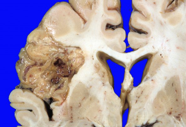 16A4 Infarct, subacute (Case 16) d