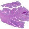 17A1 Infarct, subacute (Case 17) H&E WM