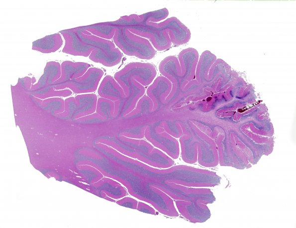 17A1 Infarct, subacute (Case 17) H&E WM