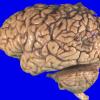 18A1 Infarct, subacute (Case 18) 2 copy