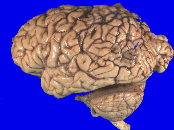 18A1 Infarct, subacute (Case 18) 2 copy