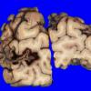 18A2 Infarct, subacute (Case 18) 8