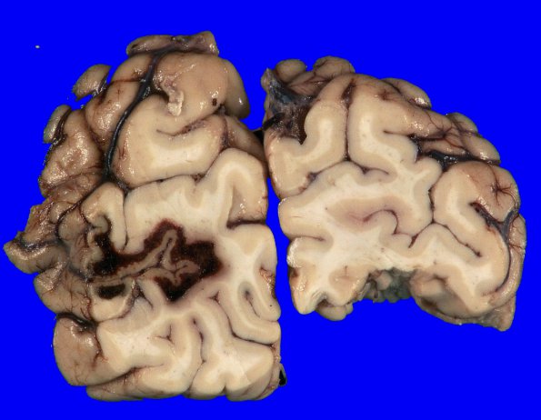 18A2 Infarct, subacute (Case 18) 8