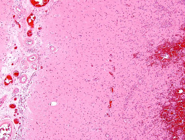 18A5 Infarct, neonatal (Case 18) N12 H&E 1