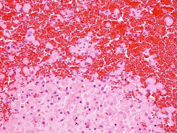 18A6 Infarct, neonatal (Case 18) N12 H&E 2