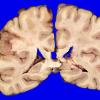 18B1 Infarct, subacute (Case 18) 4