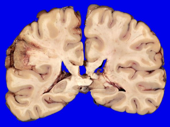 18B1 Infarct, subacute (Case 18) 4