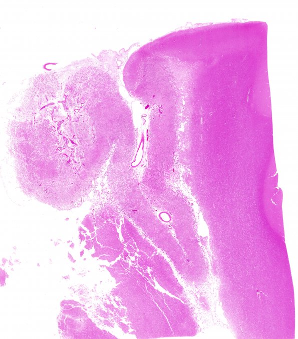 18B2 Infarct, subacute (Case 18) H&E N11 WM