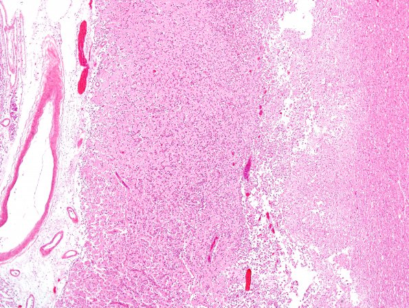 18B3 Infarct, neonatal (Case 18) N11 H&E 4