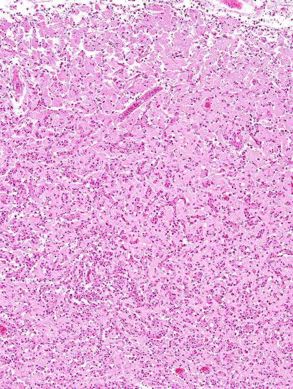 18B4 Infarct, neonatal (Case 18) N11 H&E 3