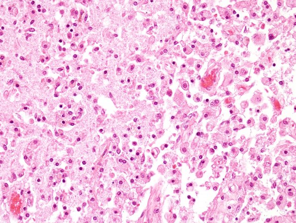 18B5 Infarct, neonatal (Case 18) N11 H&E 1