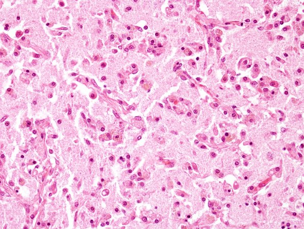 18B6 Infarct, neonatal (Case 18) N11 H&E 2