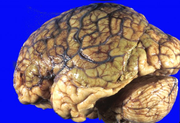 19A1 Infarct, subacute (Case 19) liver failure