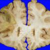 19A2 Infarct, subacute (Case 19)