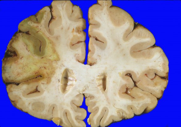 19A2 Infarct, subacute (Case 19)