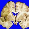 19A3 Infarct, Subacute, MCA (Case 19)