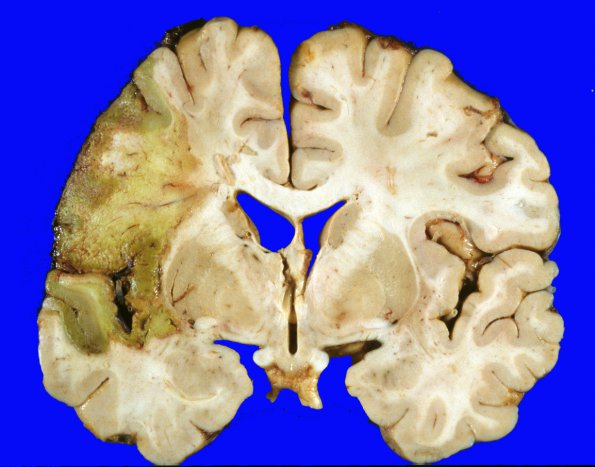 19A3 Infarct, Subacute, MCA (Case 19)