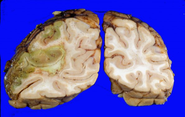 19A4 Infarct, subacute, liver failure (Case 19) a