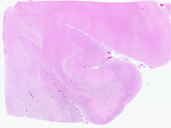 19B1 Infarct, subacute, liver failure (Case 19) Neuropath A WM