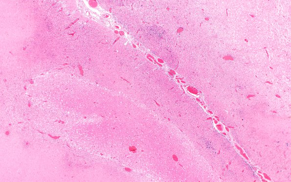 19B2 Infarct, subacute, liver failure (Case 19) Neuropath A 2X