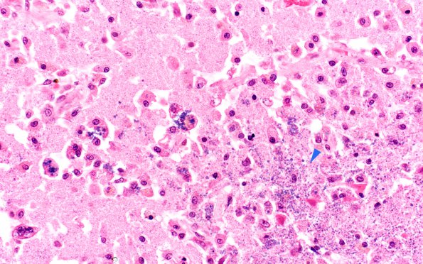 19B3 Infarct, subacute, liver failure (Case 19) Neuropath A 40X copy