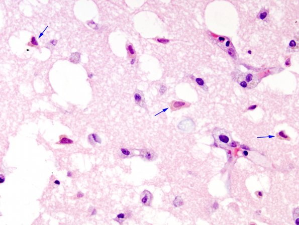 1A2 Infarct, recent-subacute, (Case 1)-7 copy