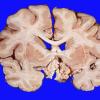 2 Craniopharyngioma (Case 2) 8