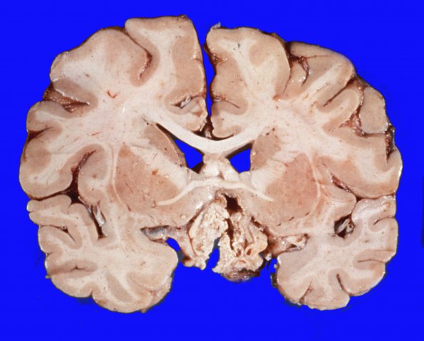 2 Craniopharyngioma (Case 2) 8