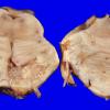 20A Infarct, subacute (Case 20A)