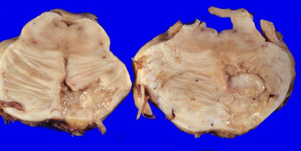 20A Infarct, subacute (Case 20A)