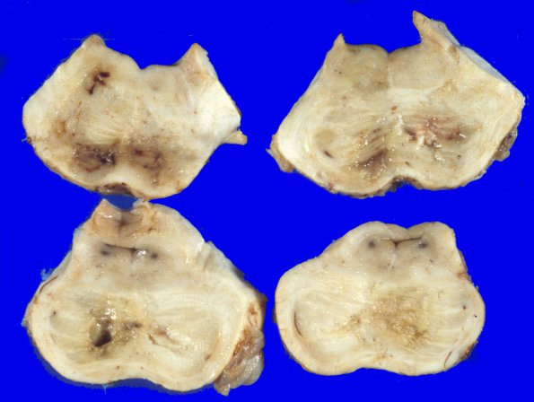 20B Infarct, subacute (Case 20B, 10 days)