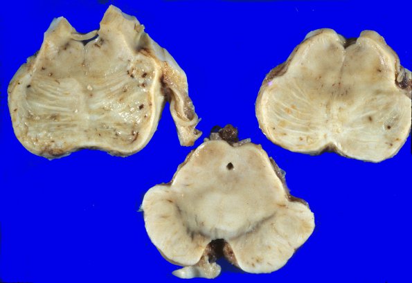 20C1 Infarct, subacute, basilar (A20C) 2