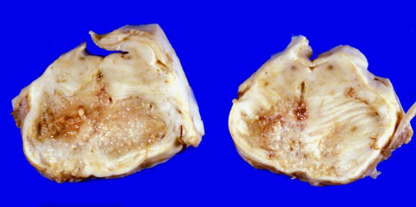 20C2 Infarct, subacute (A20C)