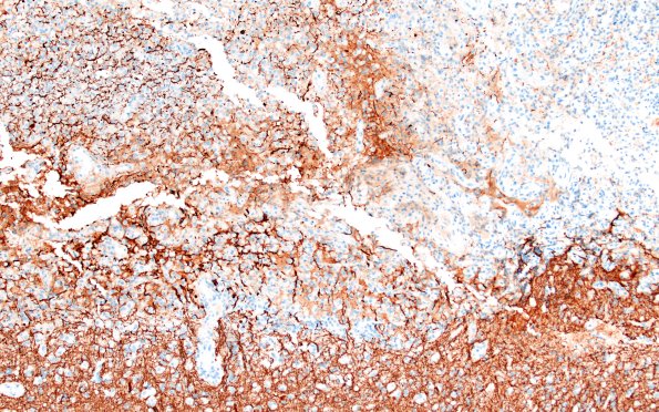 21C1 Infarct, subacute (Case 21) NF 10X