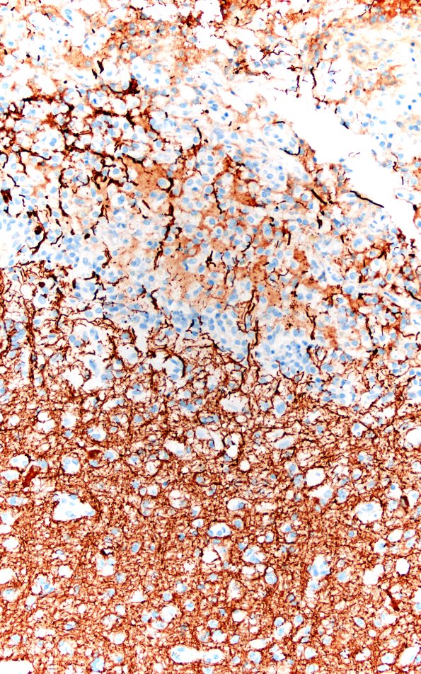 21C3 Infarct, subacute (Case 21) NF 20X 6