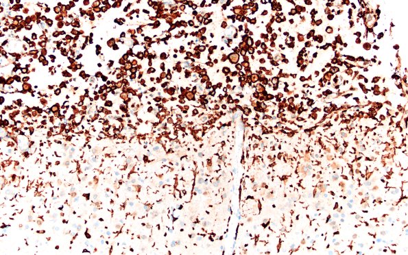 21E2 Infarct, subacute (Case 21) AreaA CD163 20X 1