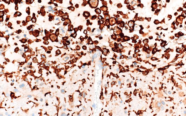 21E3 Infarct, subacute (Case 21) AreaA CD163 40X 1