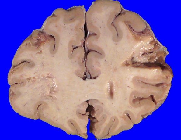 22B1A (Case 22) A.013