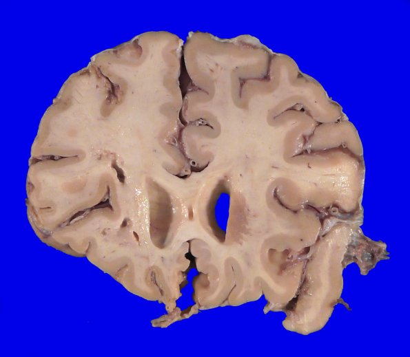 22B2 (Case 22) A.015