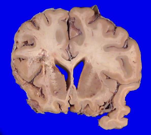 22B3 (Case 22) A.017