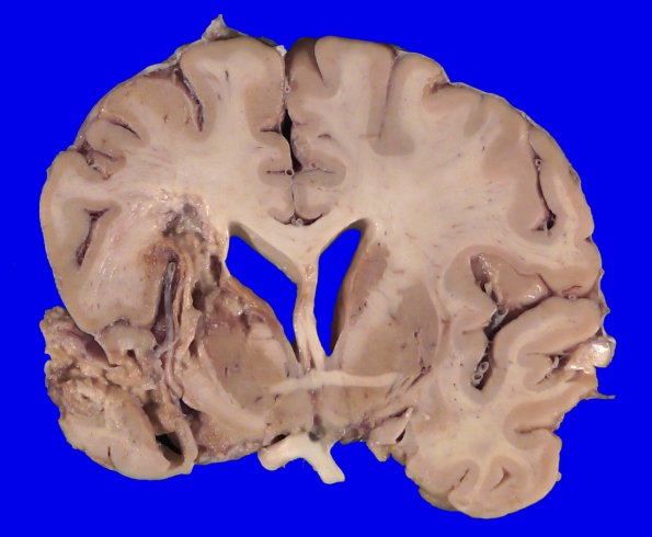 22B4A (Case 22) A.019