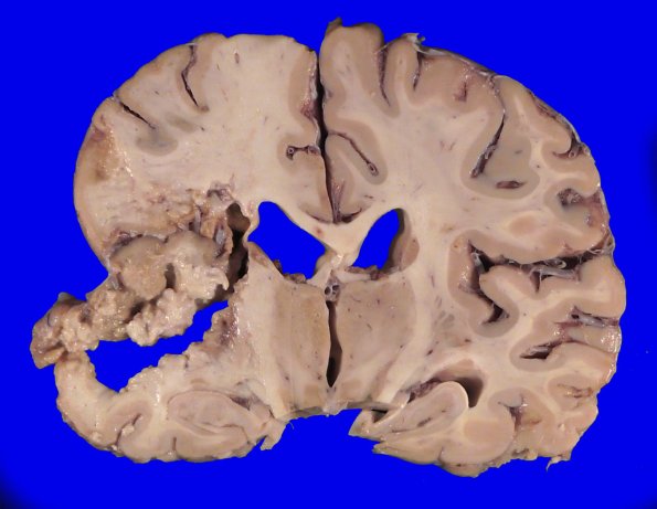 22B5 (Case 22) A.022