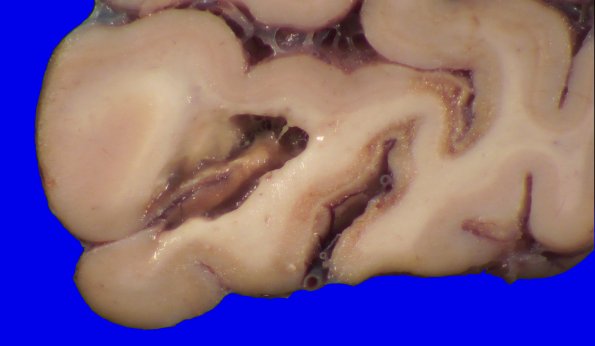 22B7B (Case 22) A.032