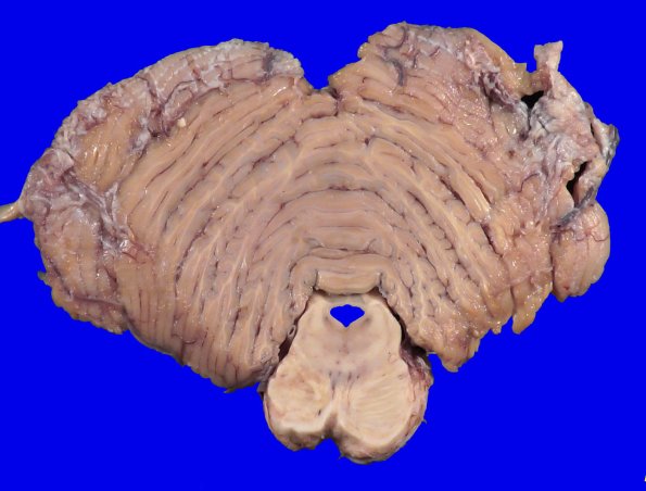22B8 (Case 22) A.036